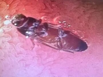 Un Joven De 23 Anos Descubre Una Cucaracha Viva En Su Intestino