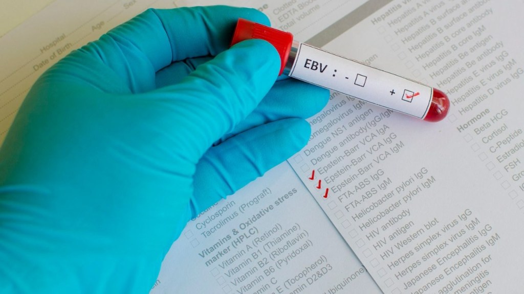 El Lupus finalmente tiene un claro culpable, es un virus común llevado por el 95% de nosotros 2 lupus - lupus