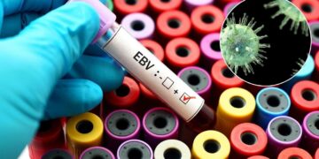 El Lupus finalmente tiene un claro culpable, es un virus común llevado por el 95% de nosotros