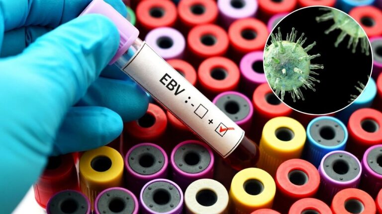 El Lupus finalmente tiene un claro culpable, es un virus común llevado por el 95% de nosotros 1 El Lupus finalmente tiene un claro culpable, es un virus común llevado por el 95% de nosotros