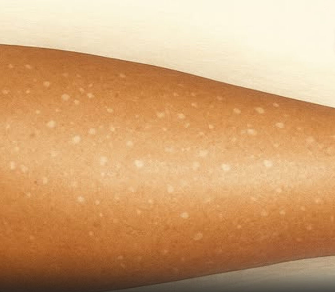 Manchas blancas en la piel que son y por que