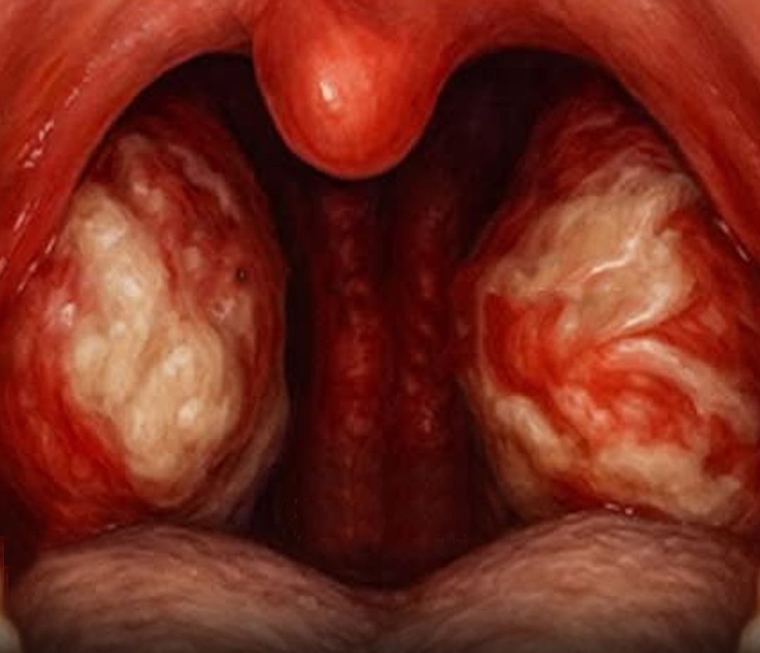 Mononucleosis infecciosa lo que debes saber sobre esta enfermedad frecuente